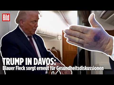 TRUMP IN DAVOS: Blauer Fleck sorgt erneut für Gesundheitsdiskussionen