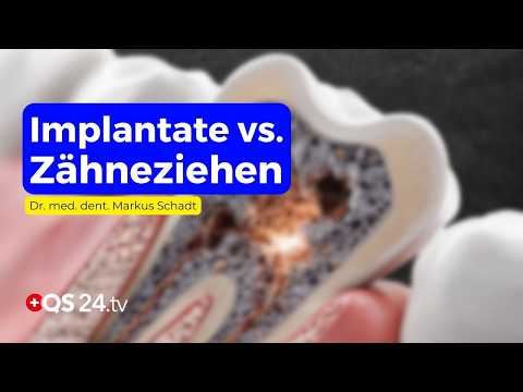 Implantate und Zahngesundheit: Risiken des zu frühen Ziehens von Zähnen | QS24 Implantate und Zahngesundheit: Risiken des zu frühen Ziehens von Zähnen | QS24