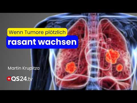 Turbokrebs – wenn der Körper plötzlich gegen sich selbst kämpft | Naturmedizin | QS24 Turbokrebs – wenn der Körper plötzlich gegen sich selbst kämpft | Naturmedizin | QS24